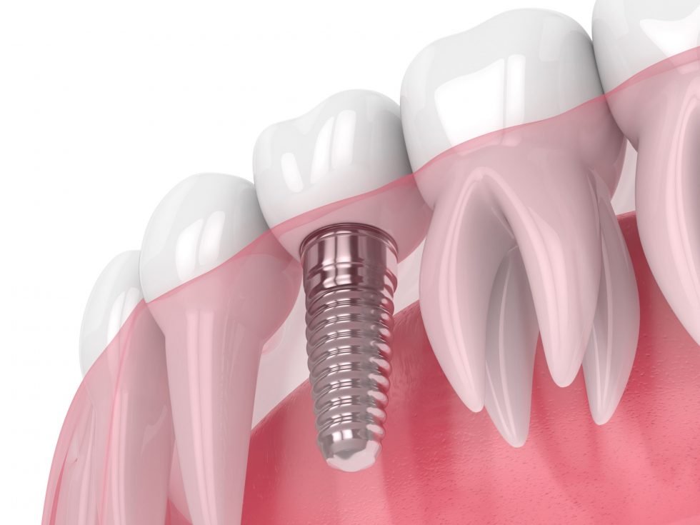 Dental Implants | Effingham Smiles Family Dentistry