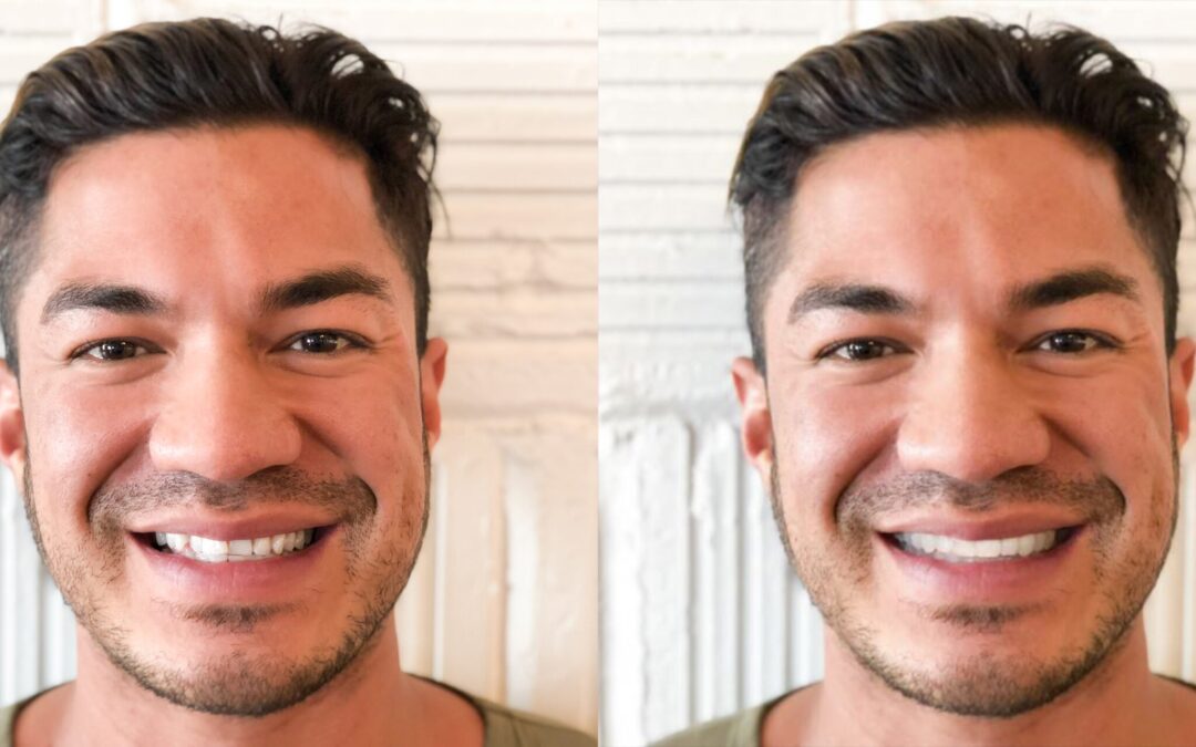 SmileView-BeforeAfter02Shane-scaled-1 | Effingham Smiles Family Dentistry